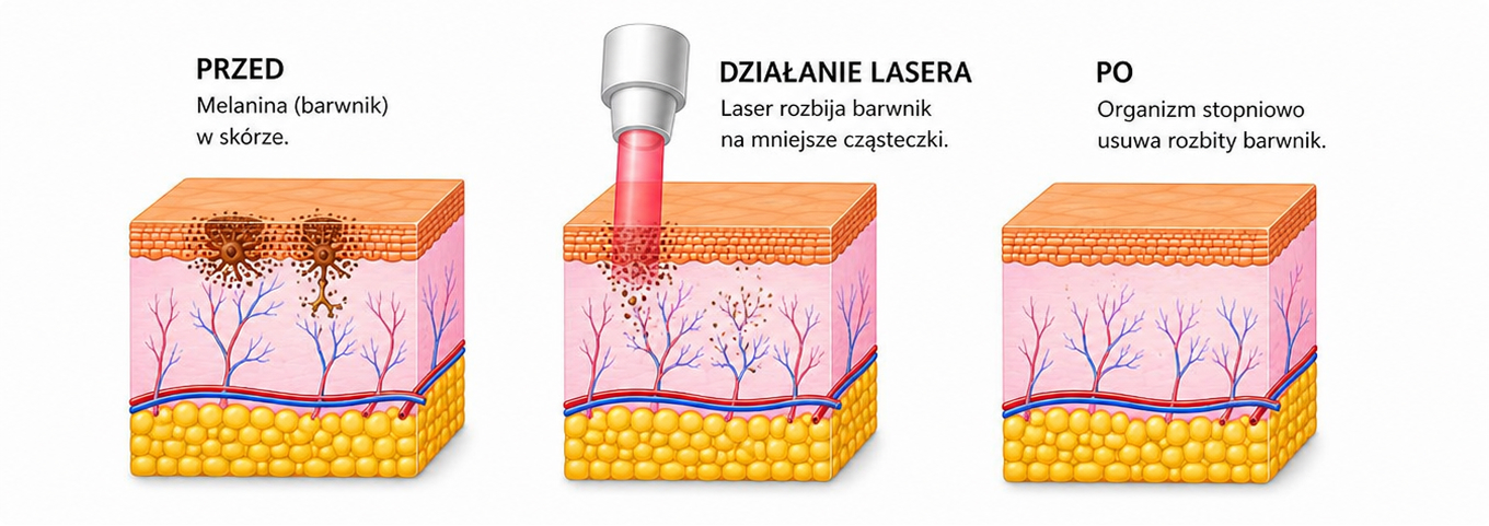 Wykonywanie zabiegu laserowego w gabinecie